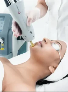 Laser Treatment